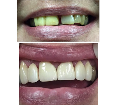 restoration of bruxism