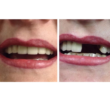 dentures