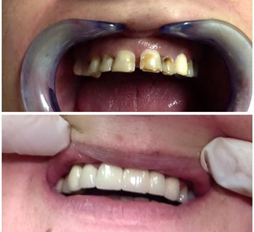 teeth white