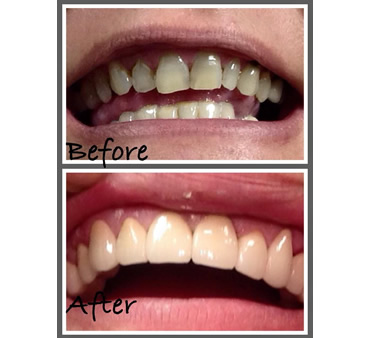 white fillings